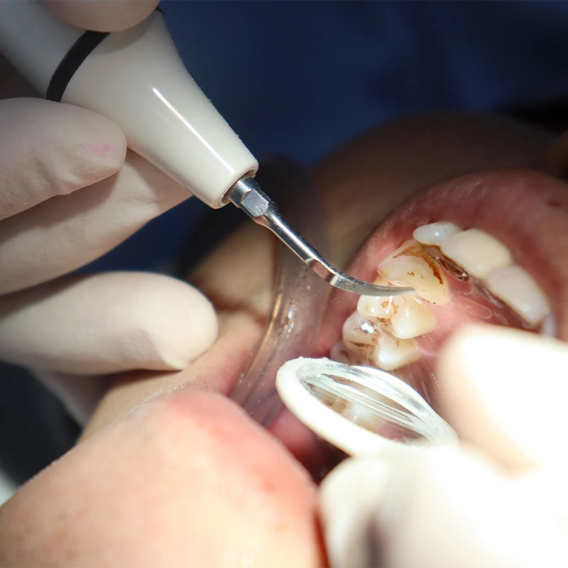 Scaler Handpiece Tube Cable fo - đánh giá và giá Teeth Whitening Youtube