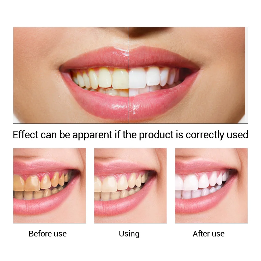 FTEENPLY Làm Trắng Răng Tinh C - đánh giá và giá Teeth Whitening Ai