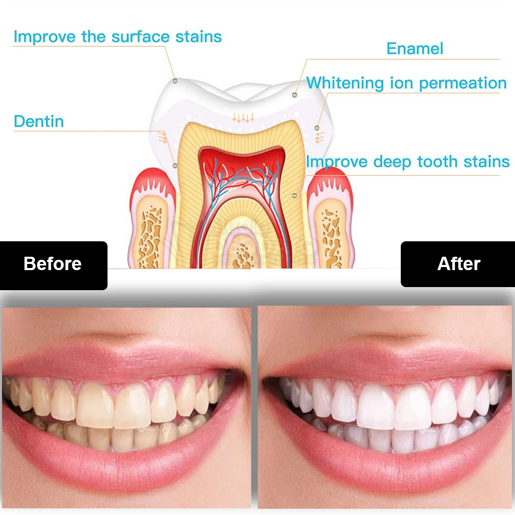 Dental Teeth Whitening Kit Min - đánh giá và giá Whitening Pen Bleach