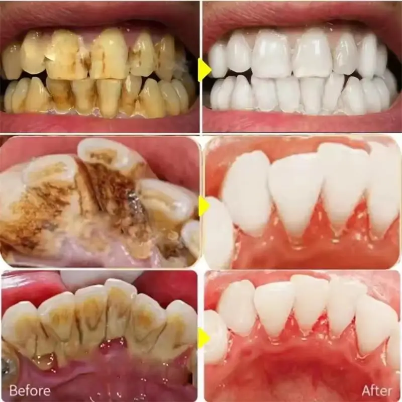Fast Teeth Whtening Toothpaste - đánh giá và giá Whitening Pen Bleach